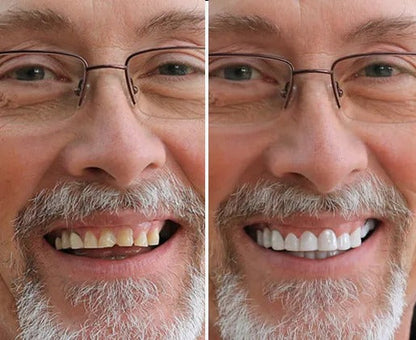 SmileSnap™ Snap-On Veneers