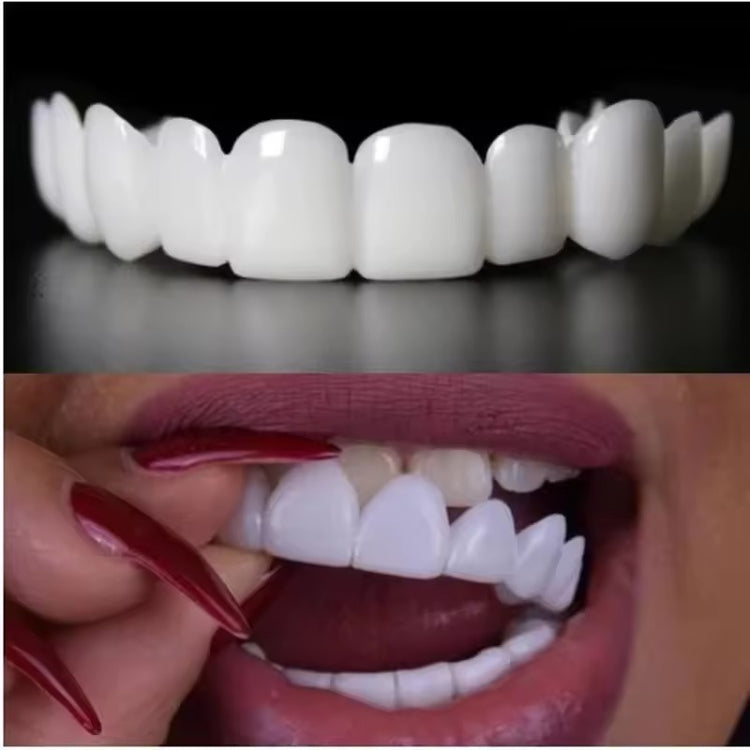 SmileSnap™ Snap-On Veneers