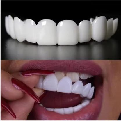 SmileSnap™ Snap-On Veneers